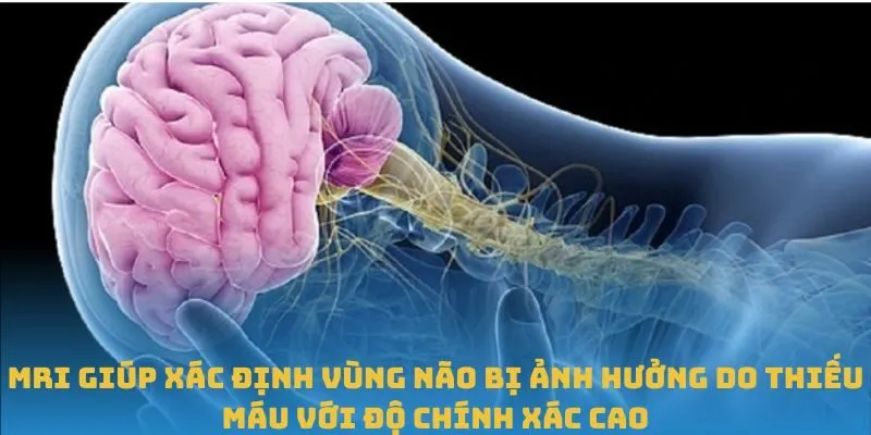 MRI giúp xác định vùng não bị ảnh hưởng do thiếu máu với độ chính xác cao
